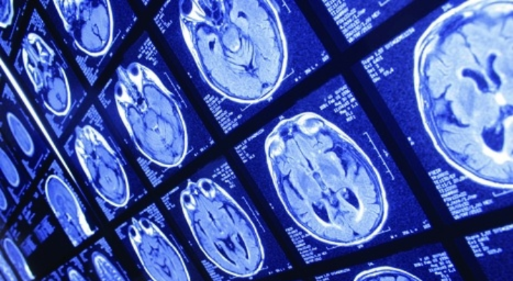 AI algorithm detects and identifies brain lesions